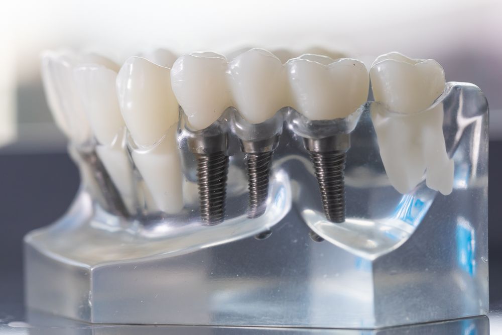 Titanium Implants